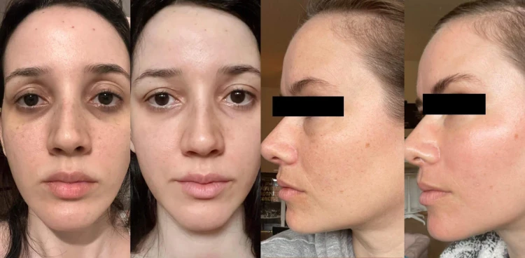 Melasma przed i po.jpeg