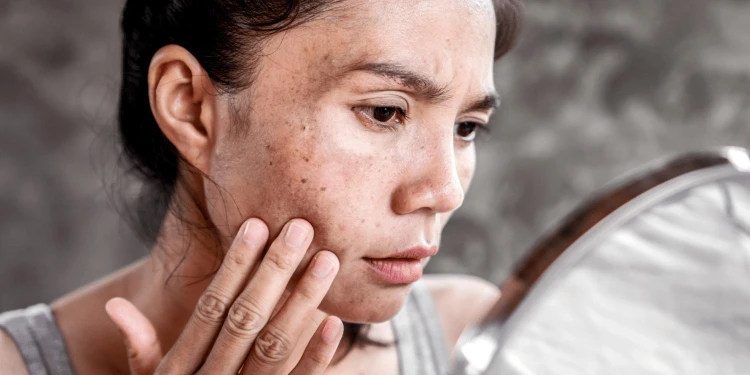 Melasma.jpeg